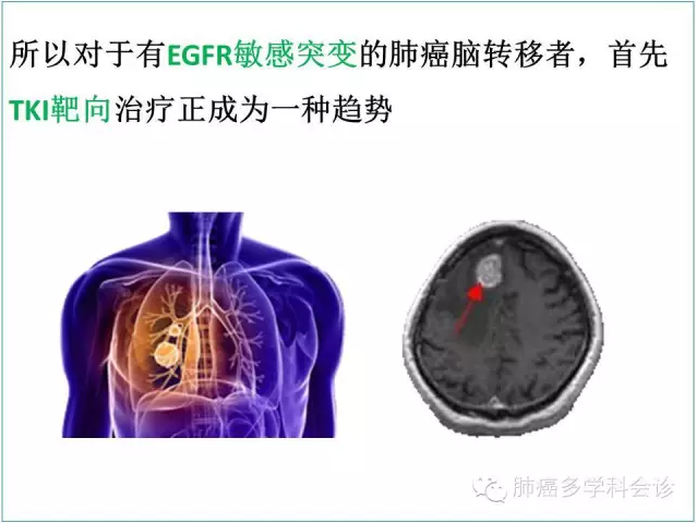 EGFR+肺癌脑转移,先靶向?还是先放疗?_好大
