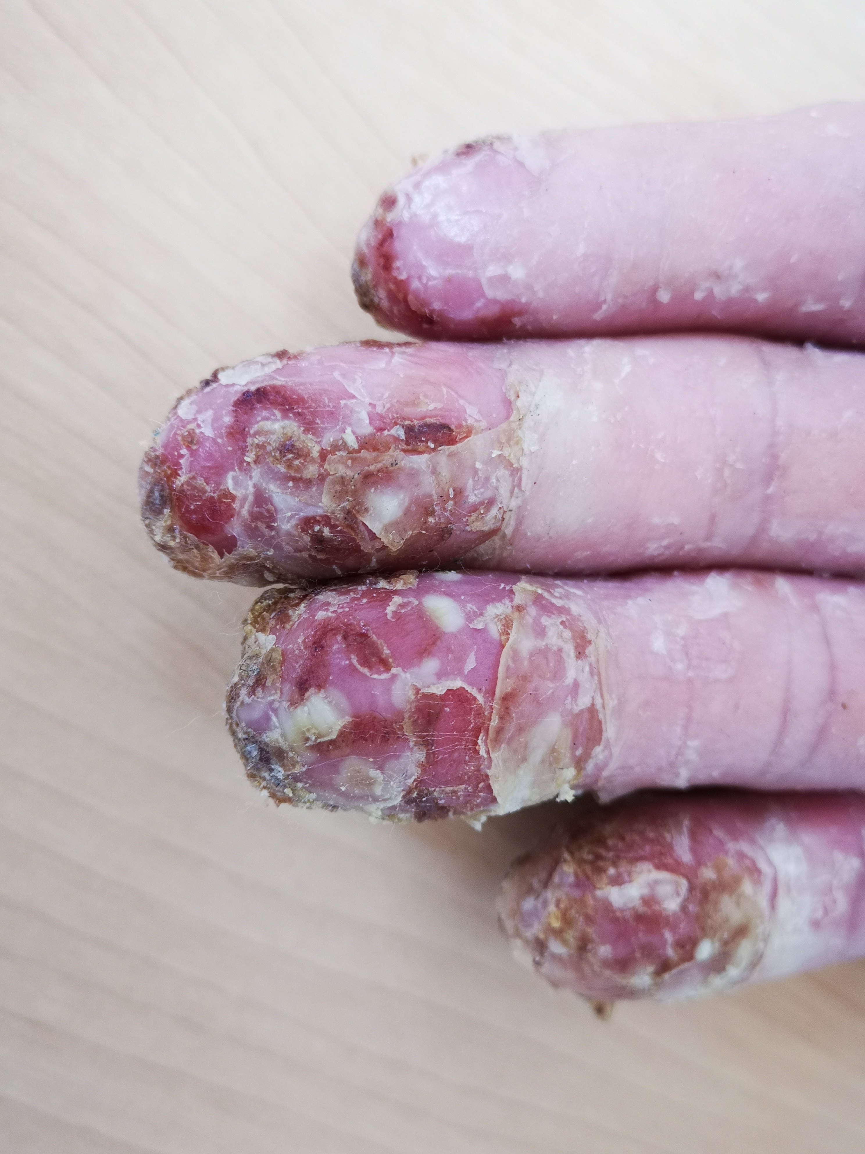 临床特征甲银屑病多发生于指甲,损害形态取决于受累部位(图1).