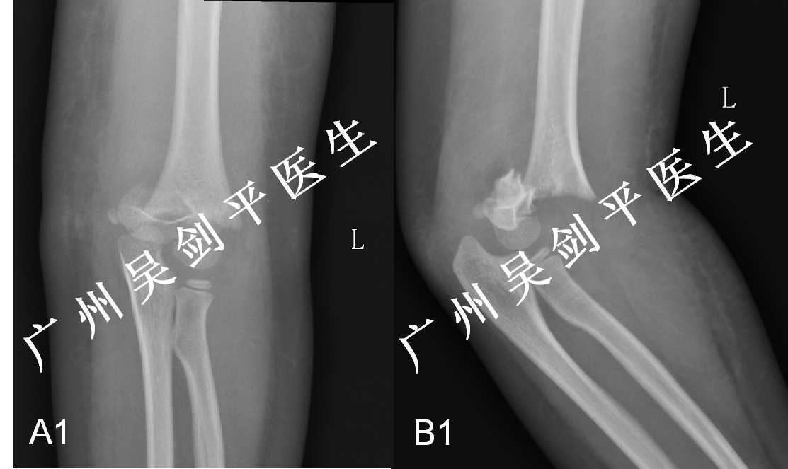 完全移位的儿童肱骨髁上骨折,我们坚持闭合复位,不开刀!