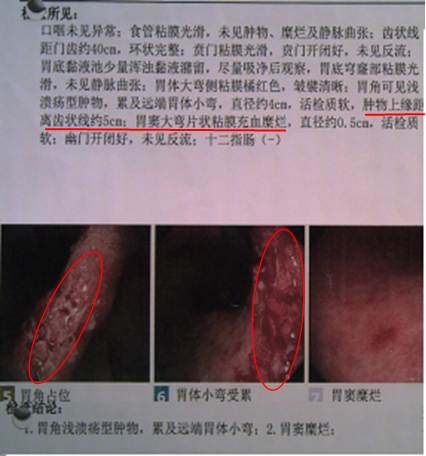 1,门诊胃镜示:胃角溃疡型肿物,累及胃体小弯,直径约4cm,胃窦糜烂.