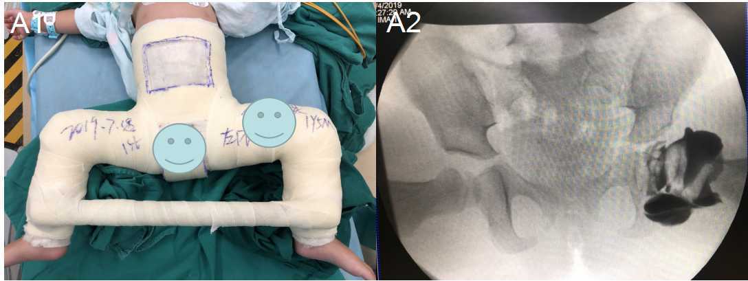 儿童发育性髋关节脱位我们这样诊治