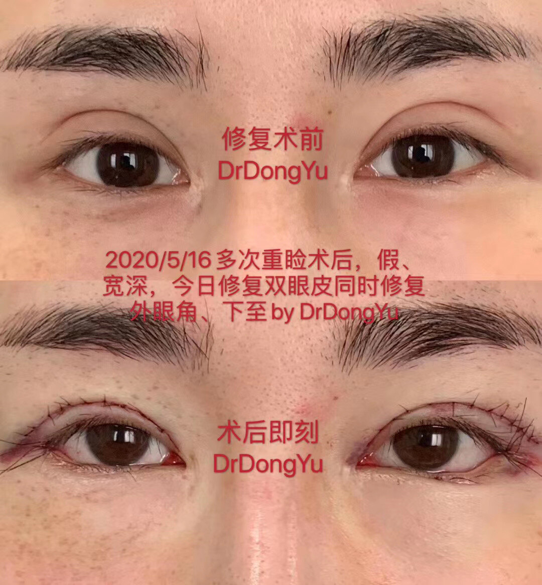关键词:宽,深,假,同时修复了外眼角和下至