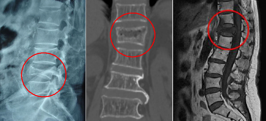 全身骨扫描(ect)及pet/ct:在转移性骨肿瘤的诊断中更具有显著作用.