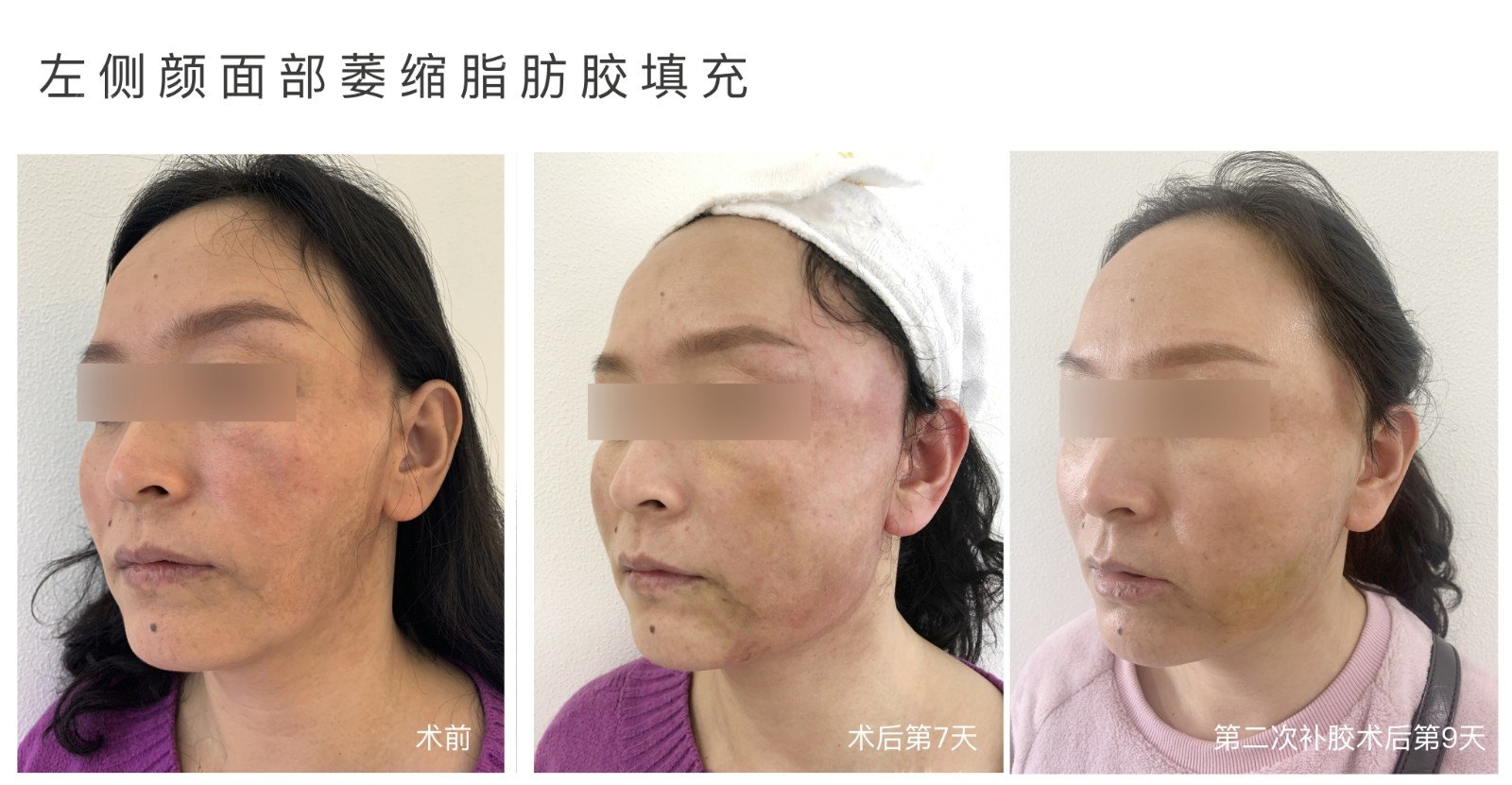 【进行性半侧颜面萎缩引】一边鲜花盛开,一边已是美人