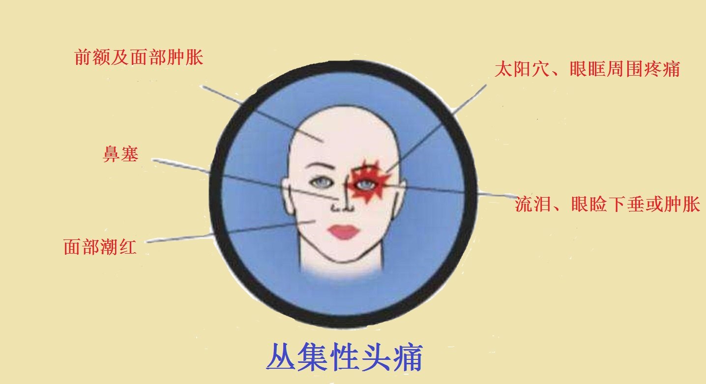 是所有头痛中疼痛程度比较严重的一种,属于血管性头痛之一或是偏头痛