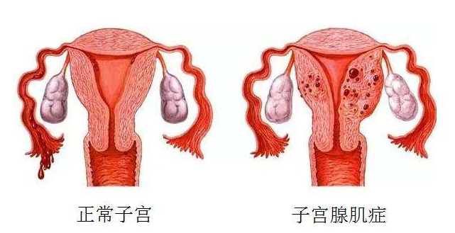 20多岁的女孩子患上腺肌症,该如何是好!_子宫腺肌症