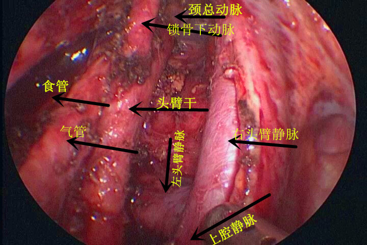 右上纵膈肿瘤胸腔镜下全切,右上纵膈血管解剖如此清晰!