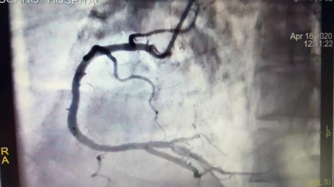 冠状动脉痉挛一例