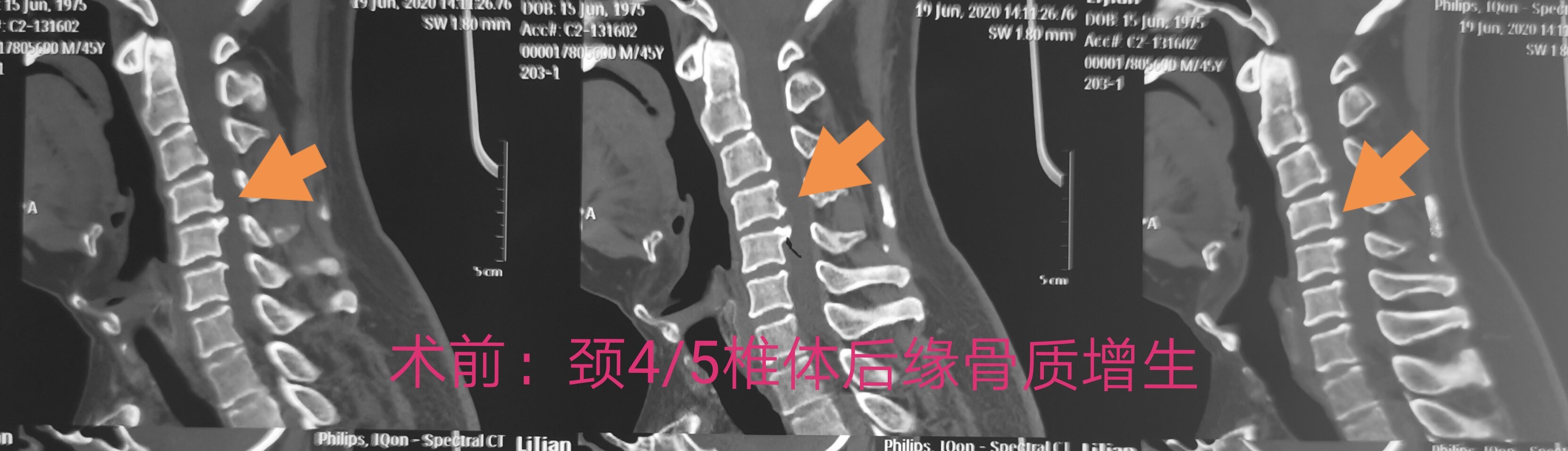 颈椎间盘突出 好大夫在线