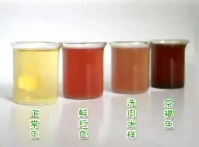 尿色深,依据肌红蛋白浓度的高低可分为洗肉水色,红褐色,酱油色,可乐色