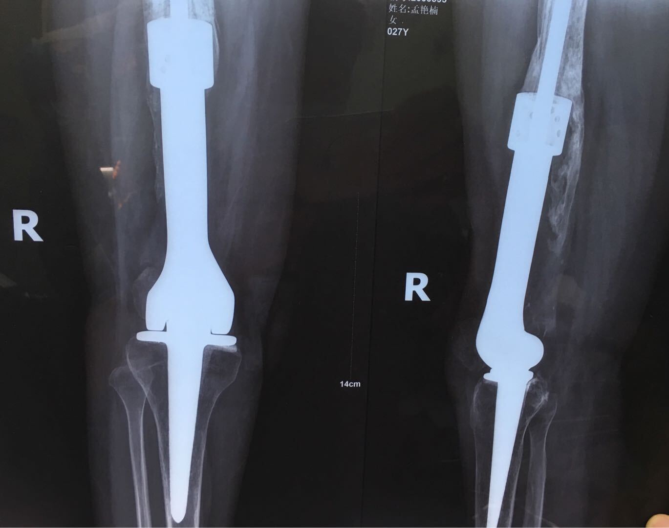 女 27岁"右股骨远端骨肉瘤 瘤段切除 膝关节假体置换手术后10年余