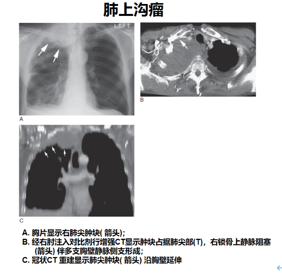 表现为包括肺尖肿块(60%),单侧或不对称性肺尖胸膜增厚("胸膜帽",40%)