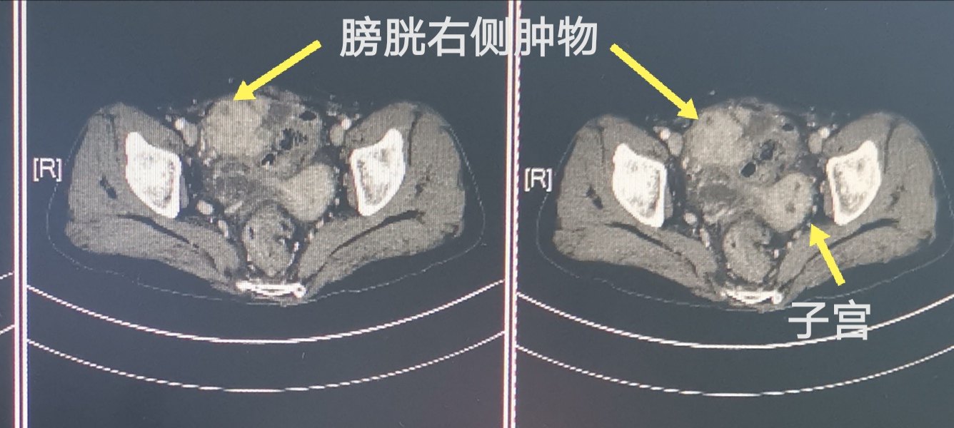 病例113-阑尾炎脓肿实为阑尾腺癌直接浸润累及右侧腹壁,卵巢,膀胱伴