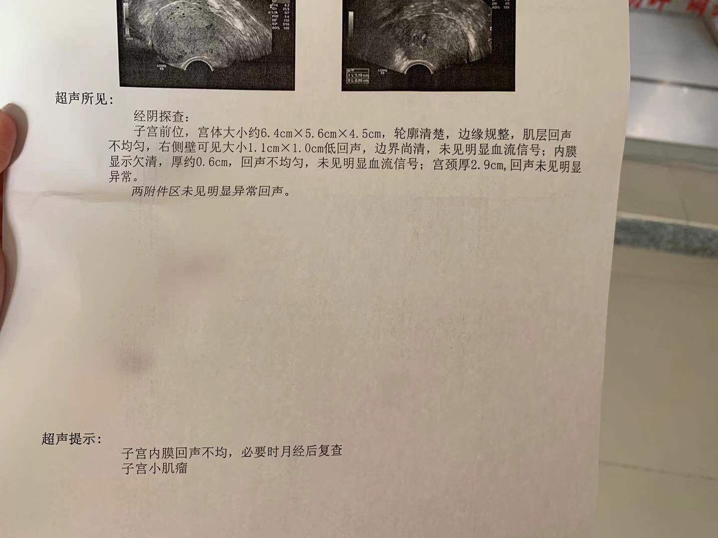 中药治疗5天后外院复查b超
