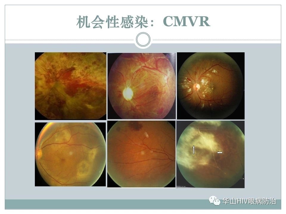 艾滋病在眼部有什么并发症?