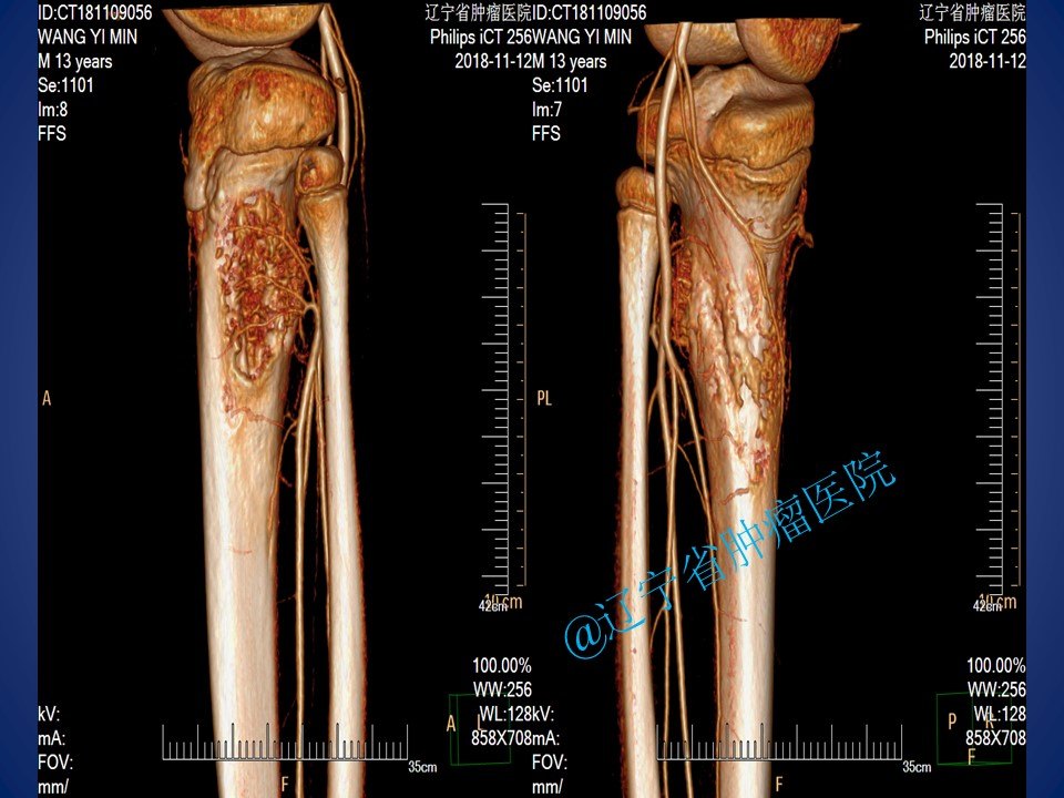 胫骨骨肉瘤肿瘤型可延长膝关节假体置换手术病例