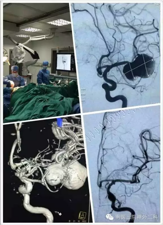 "杂交手术"治愈颅内复杂形态巨大动脉瘤
