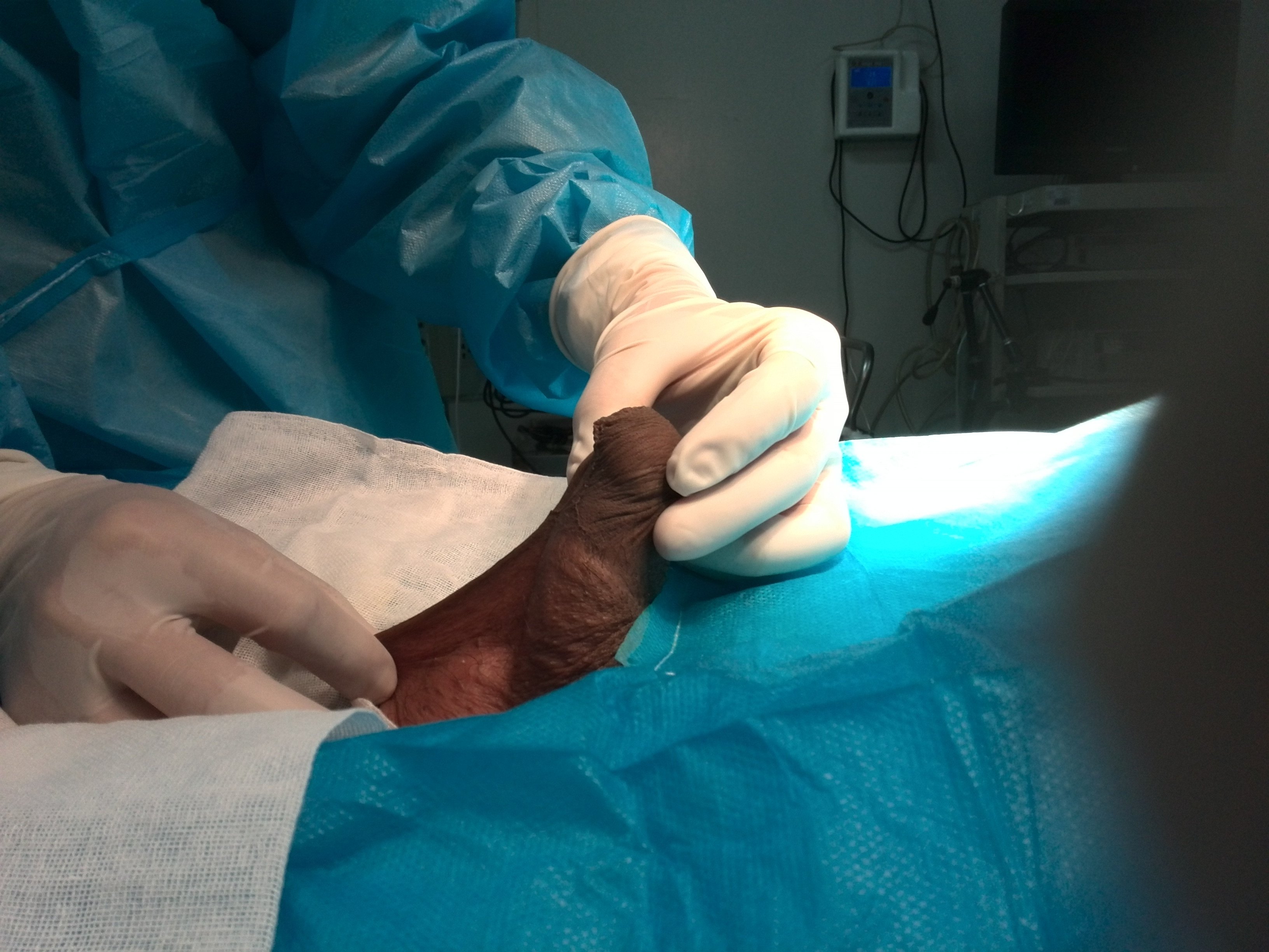 蹼状阴茎的术前术后 - 好大夫在线 ·智慧互联