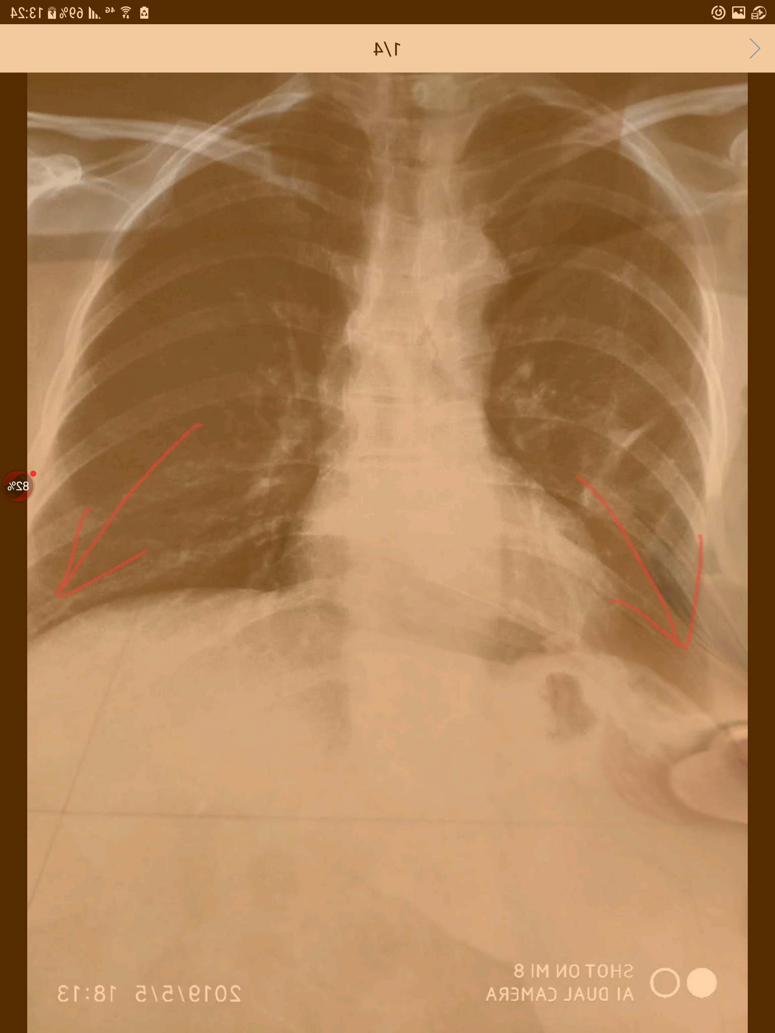 刘懿博士说肺癌八六〇肺癌术后胸片显示肋膈角锐利是什么意思
