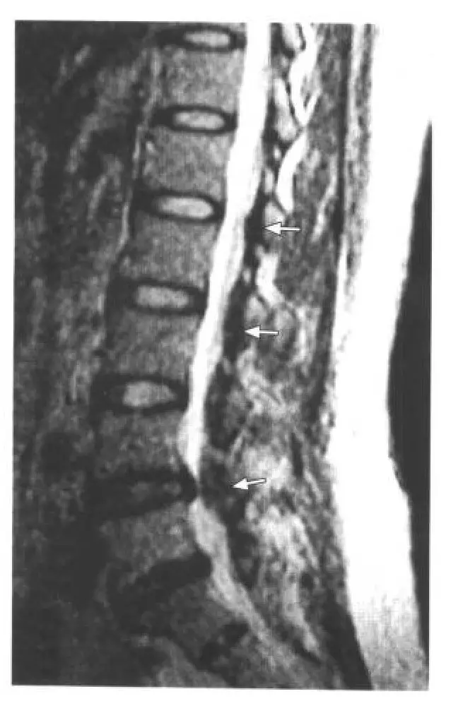 矢状面t2加权像:腰椎多个平面黄韧带肥厚,硬脊膜囊后缘受压,呈搓板样