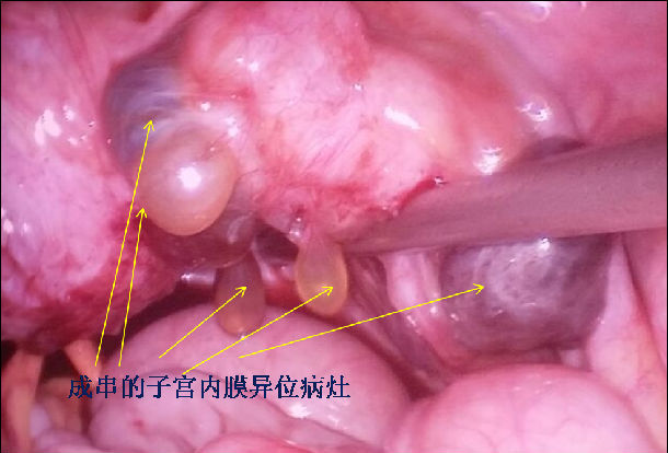 宫腔粘连之一:月经没了,每月下腹痛