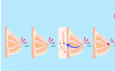 乳腺癌保乳手术会影响生存期吗?