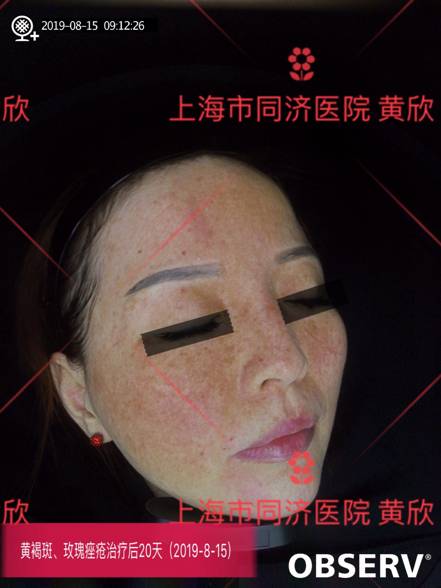 黄褐斑玫瑰痤疮