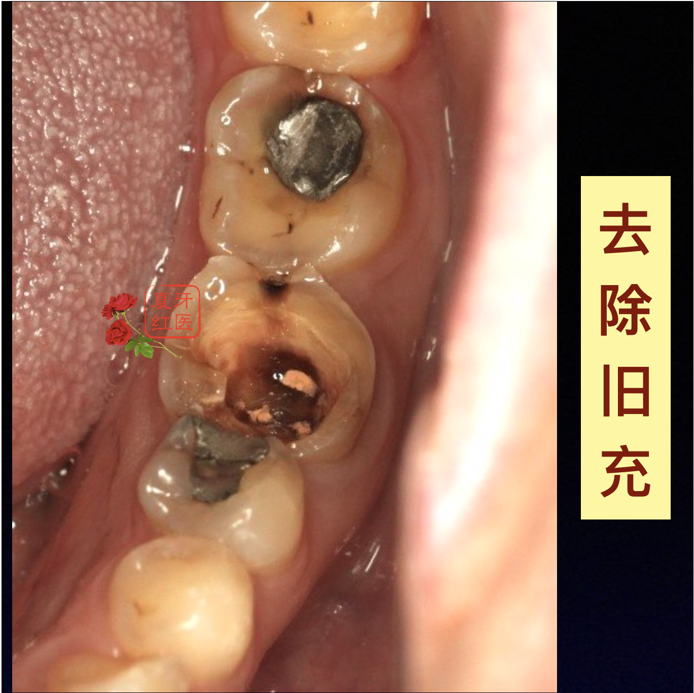 为什么根管治疗的主力牙如果大面积牙体缺损一定要进行桩冠修复