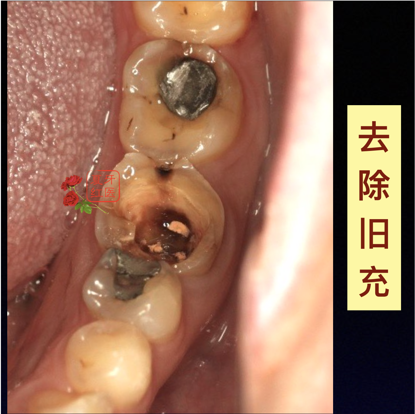 【为什么根管治疗的主力牙如果大面积牙体缺损,一定要进行桩冠修复?