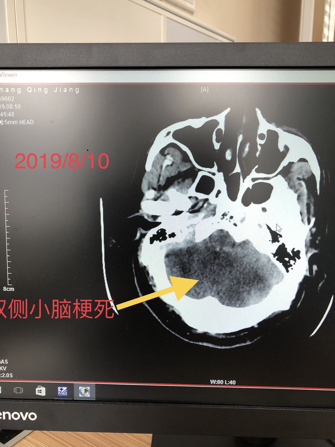 急诊入住许昌市人民医院神经内科,入院行头部ct检查发现双侧小脑梗死