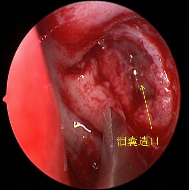 慢性泪囊炎只需鼻腔造个小口解决