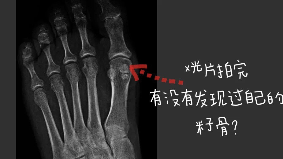 脚趾痛的罪魁祸首竟是它?--籽骨炎