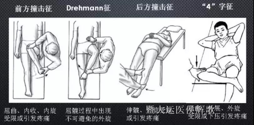 髋关节疼痛是不是患了很多医生都会漏诊的这种病