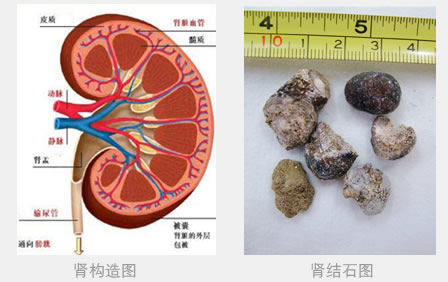 怎么就知道肾结石排出了?