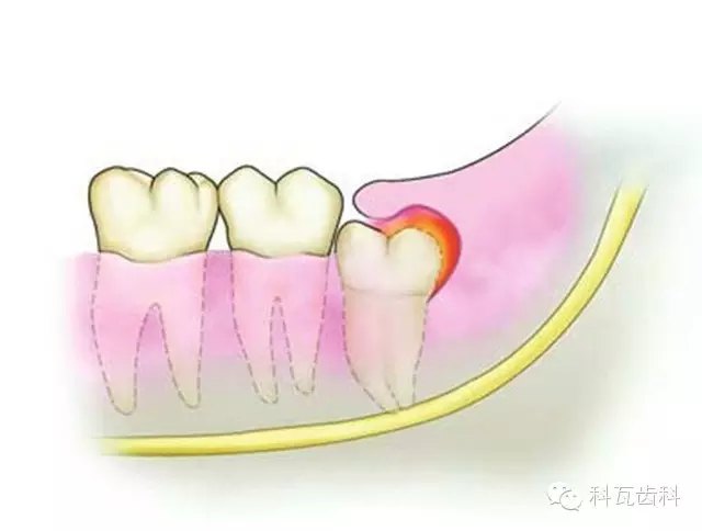 智齿冠周炎   智齿冠周炎是指智齿牙冠周围的软组织炎症,常发生于18