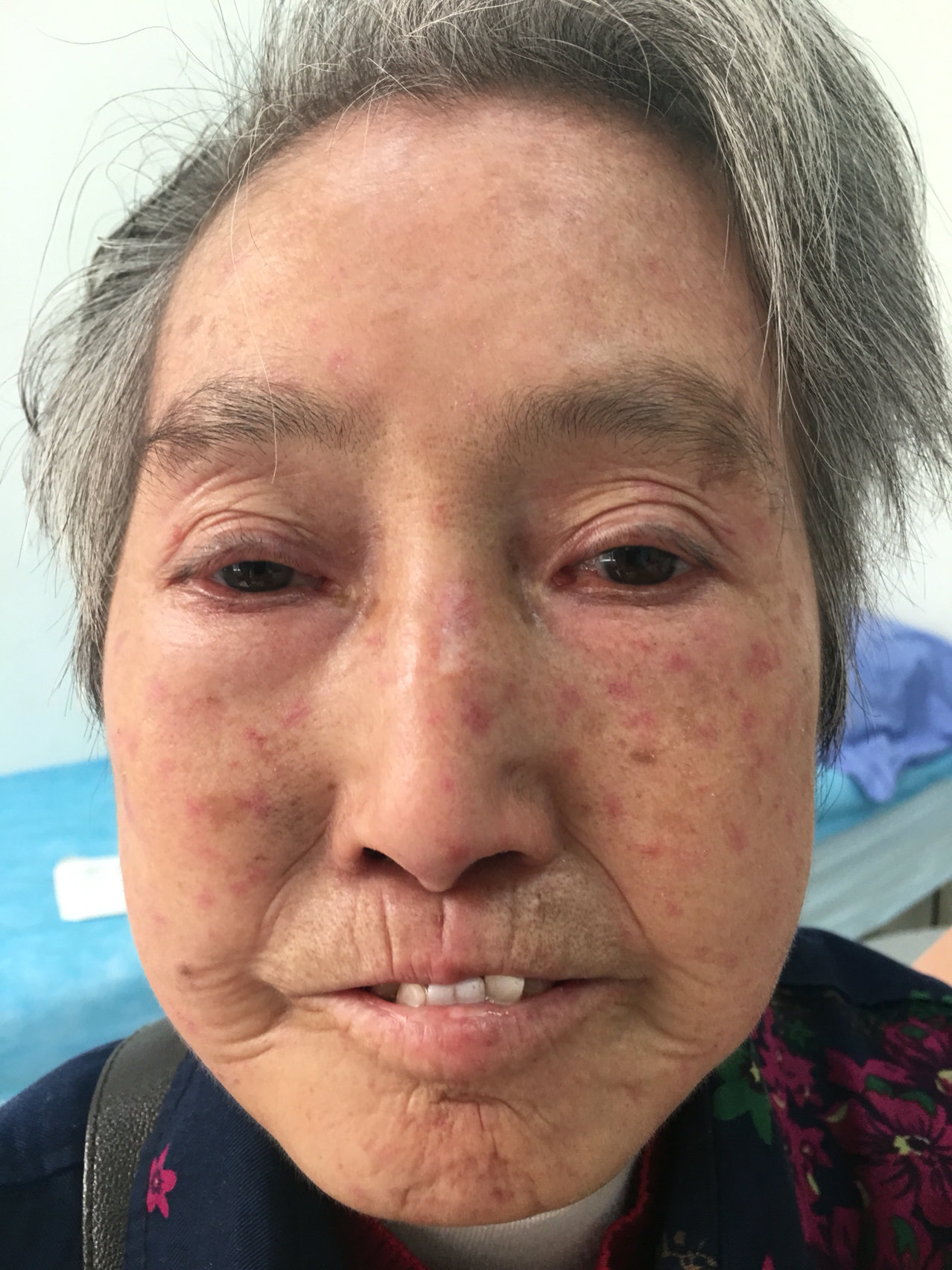 硬皮病临床表现及诊治