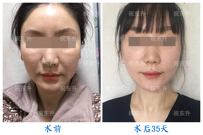 50岁左右面部松弛,拉皮手术能带来多大的改变?