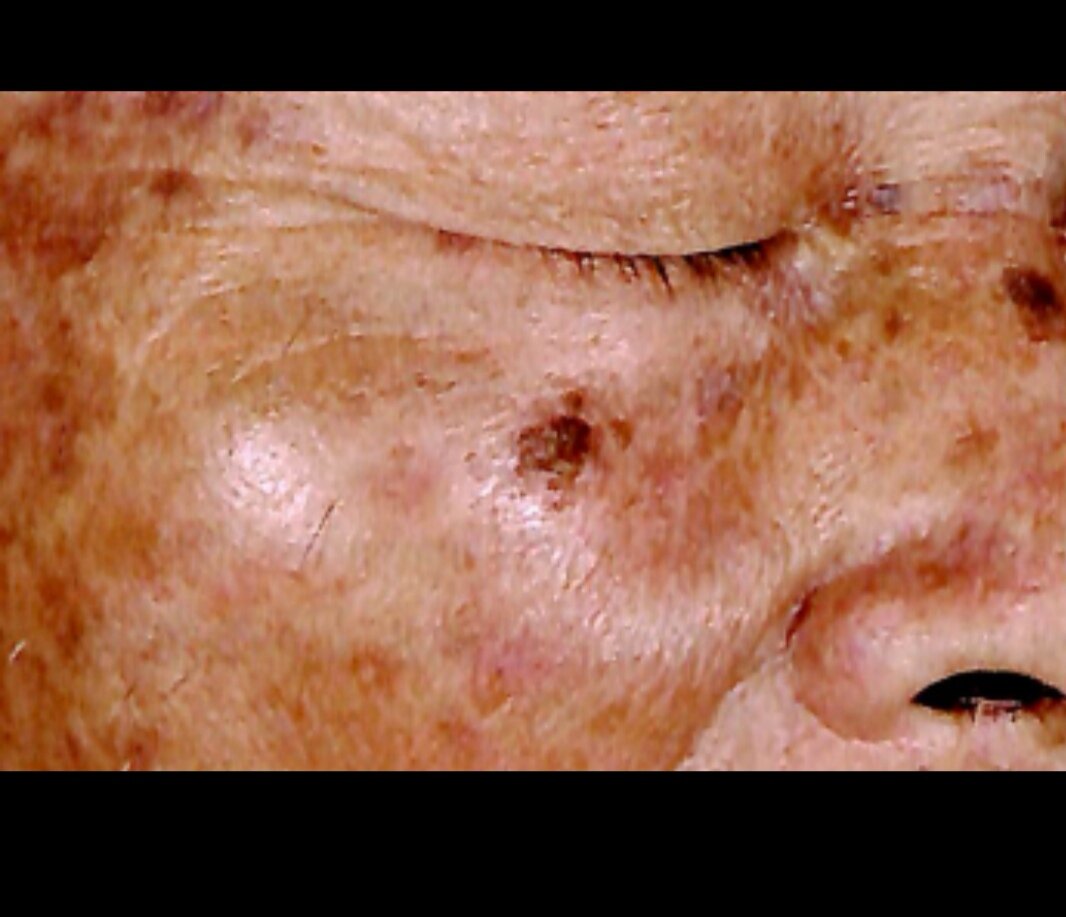 【診療Tips】顔の日光角化症 - マイナー外科・救急