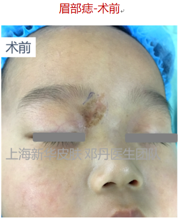 案例解析本期分享的是一例儿童面部-眉部的色素痣的案例,采用手术