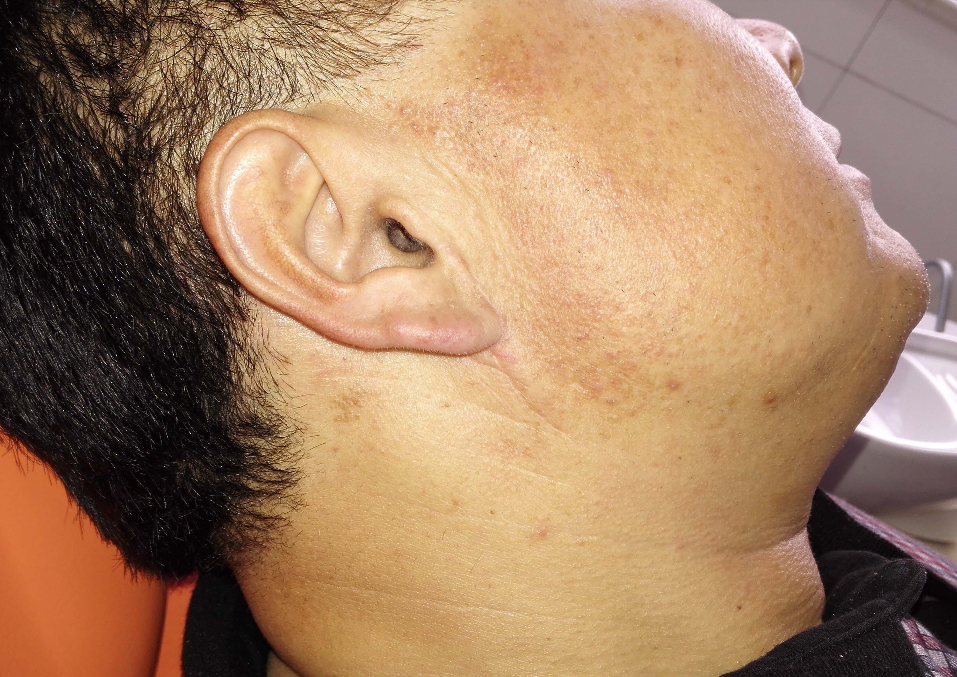 腮腺混合瘤患者术前会有很多担心,其一就是担心术后面部留有明显疤痕