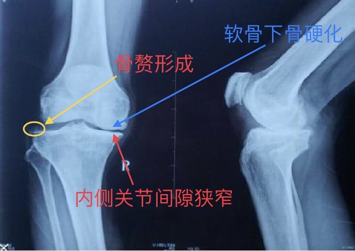 膝关节骨性关节炎X线片膝关节正常X线片膝关节的x线检查有助于判断