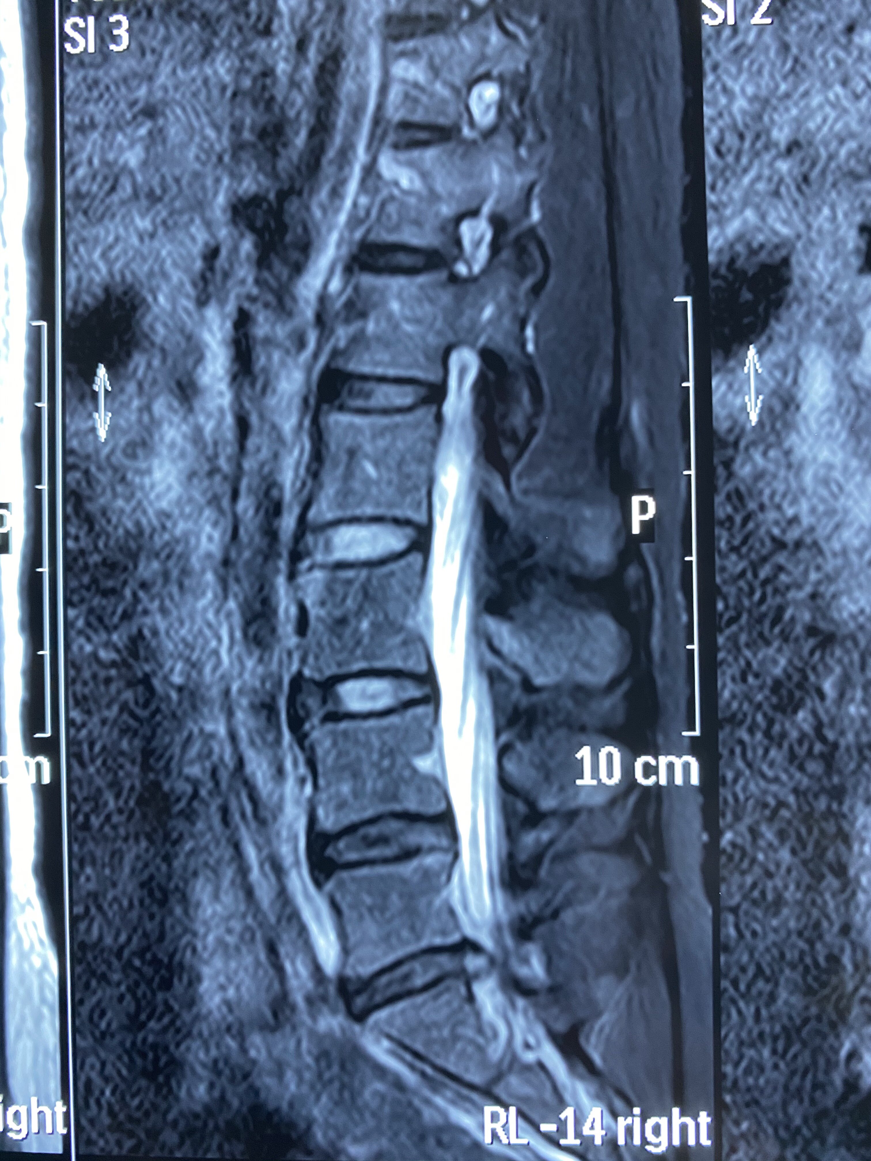 mri显示腰5-骶1椎间盘突出压迫硬膜囊严重