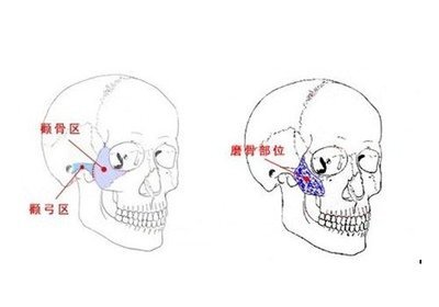 王瑞晨博士科普:颧骨颧弓手术后的你应该这么做!(照片