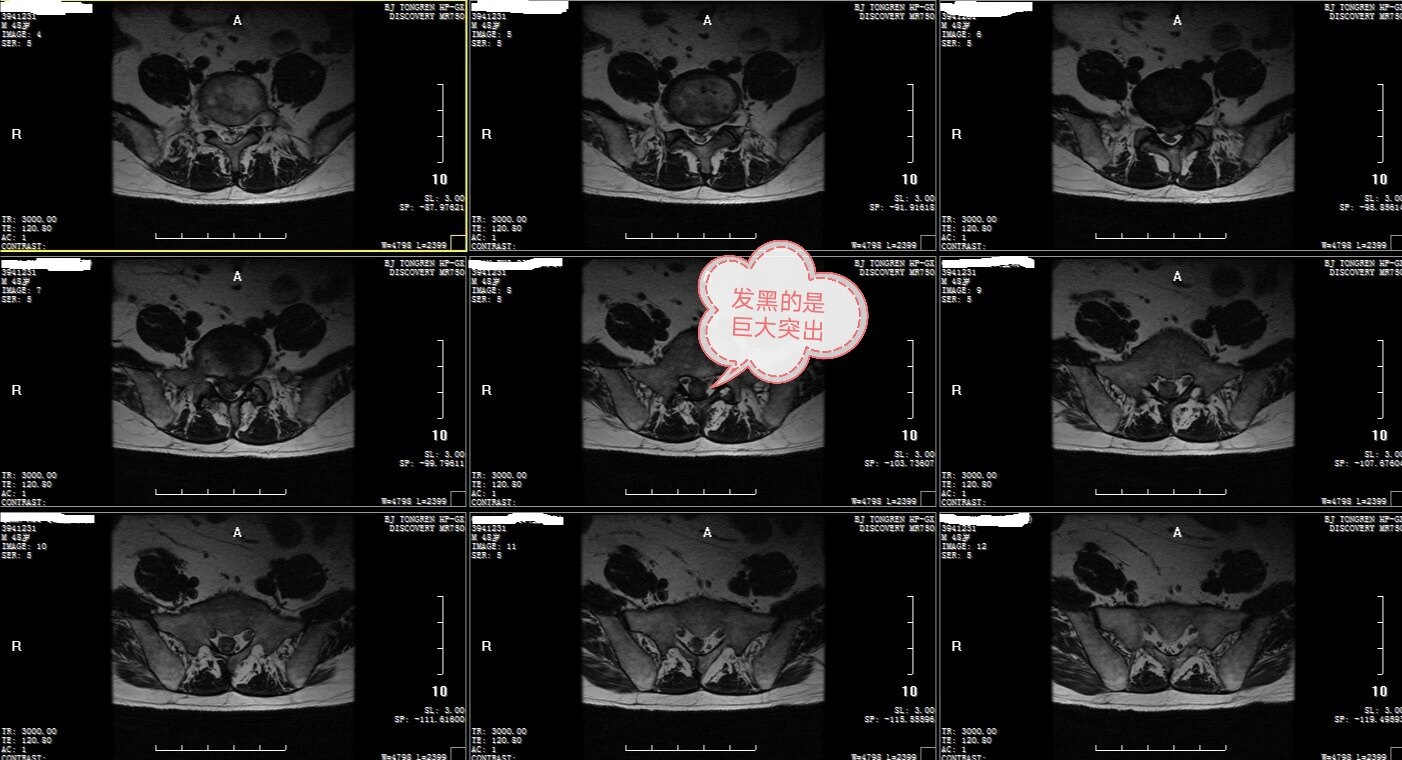 入院时腰椎核磁,平扫水平位,可见突出物位于椎管中央偏右.