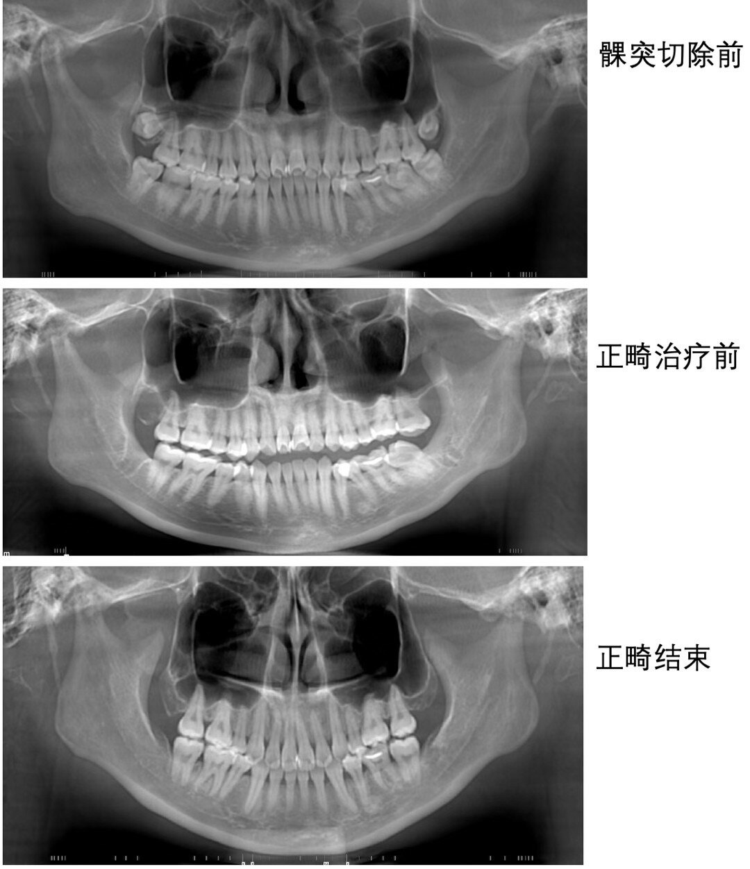 髁突切除术后标准化正畸治疗单侧髁突肥大病例展示