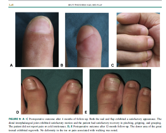 血管化断层甲床瓣移植修复指尖甲床缺损或畸形,可有效减少术后足趾