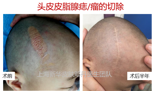 皮脂腺痣头皮治疗热门问答