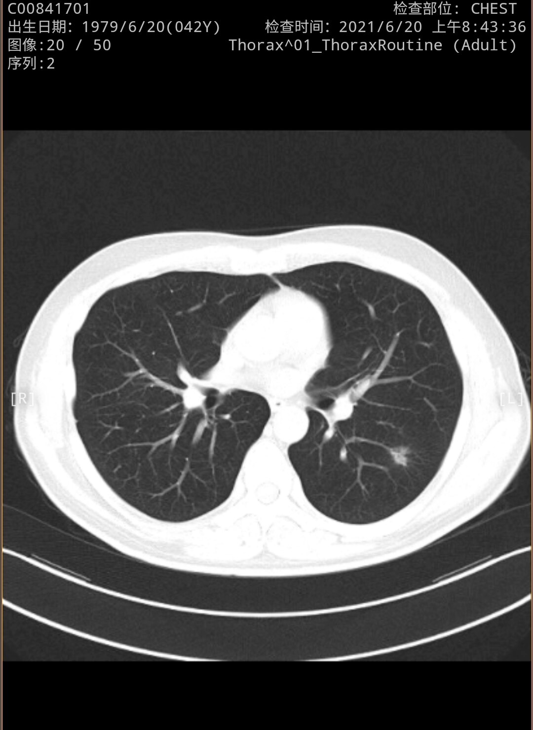 刘懿博士说肺癌(二二亖三)四十二岁相隔一年肺部出现磨玻璃结节