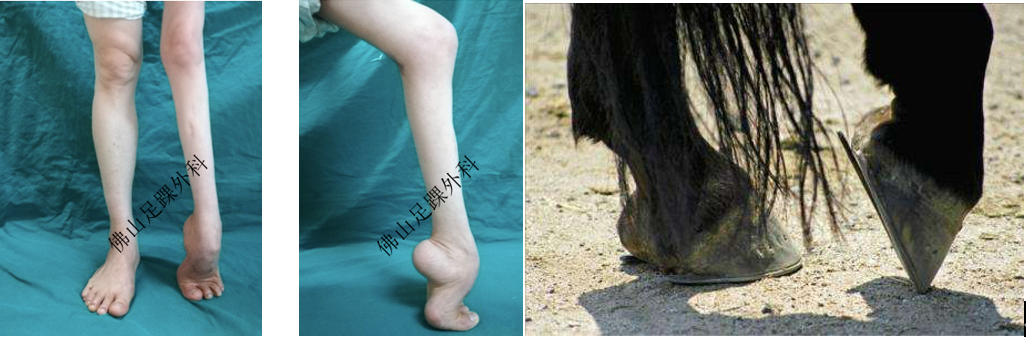 马蹄足又称下垂足,尖足,患者在走路的时候足尖先着地而后足跟着地.
