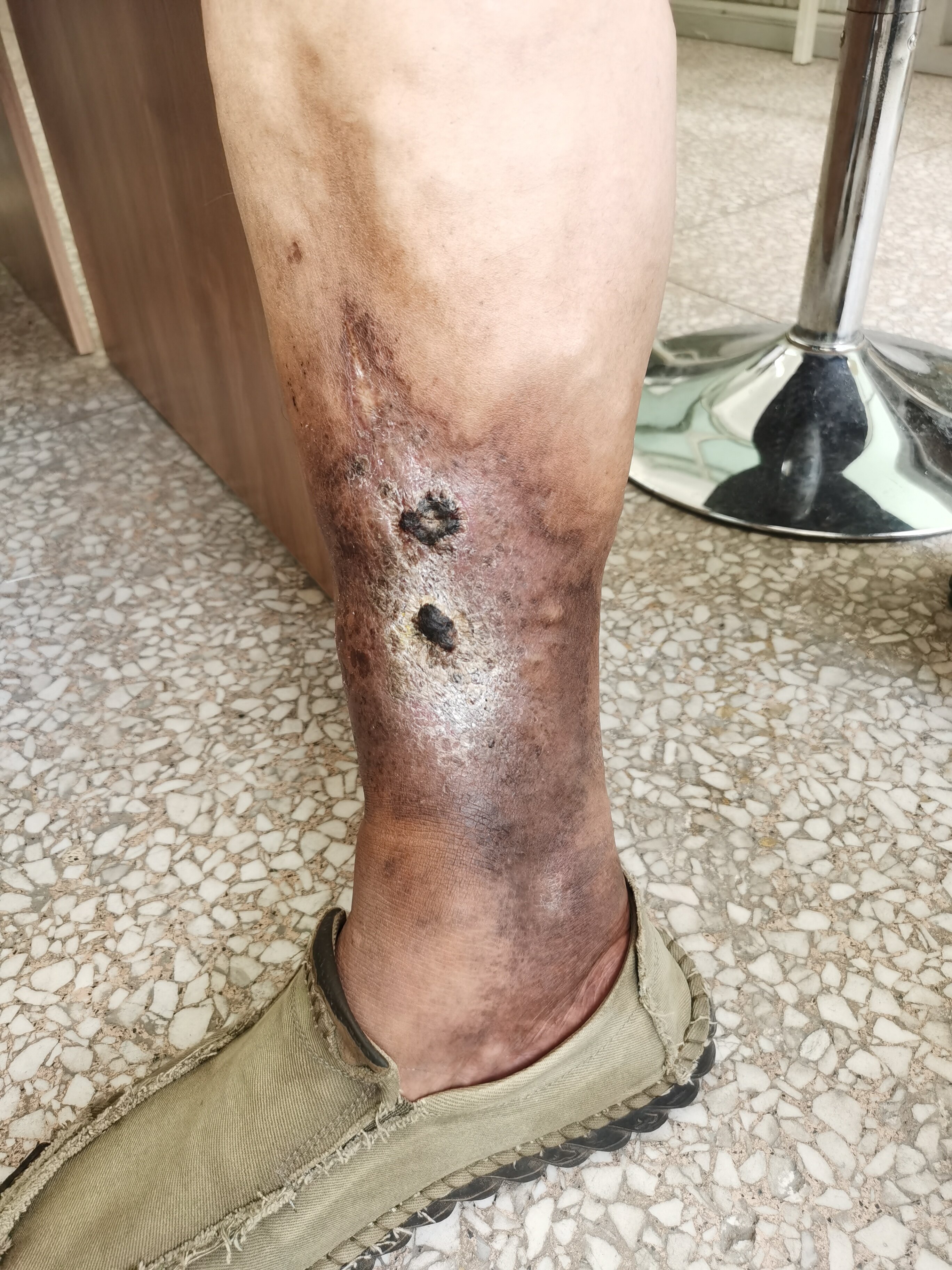 男46岁臁疮腿中药泡洗治愈